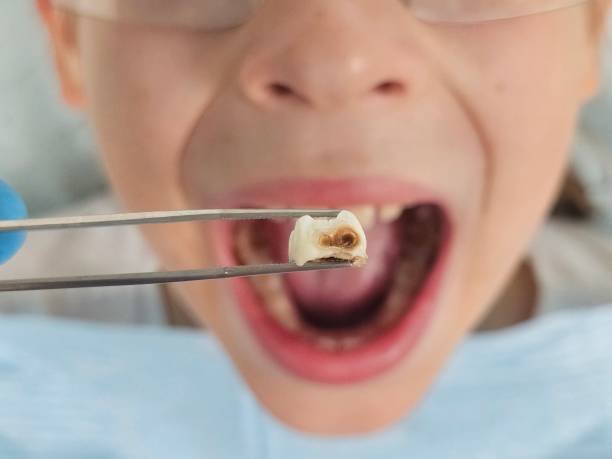 Best Emergency Wisdom Teeth Removal in Darien, IL